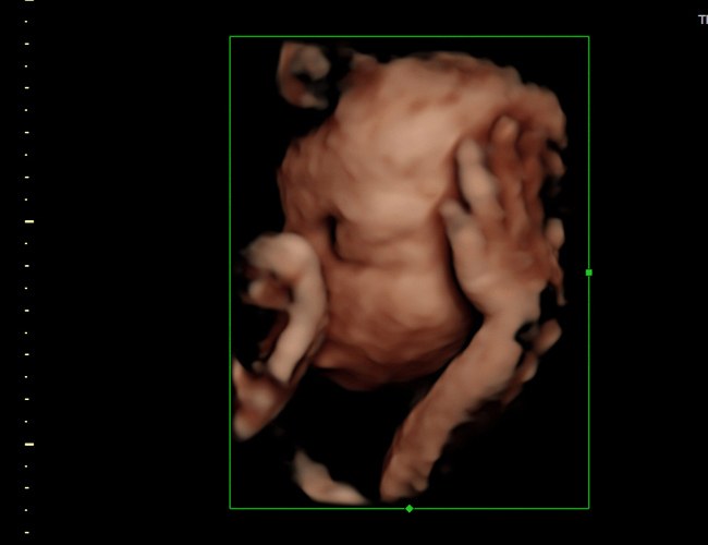3D ultrasound image at 29 weeks
